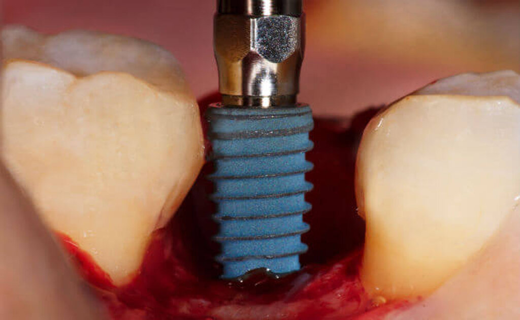 Восстановление зубов имплантацией