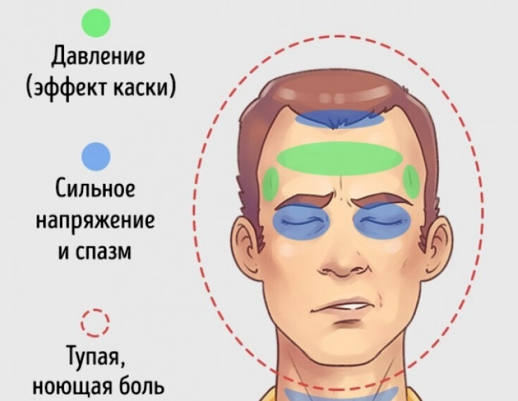 Головная боль напряжения: симптомы и лечение