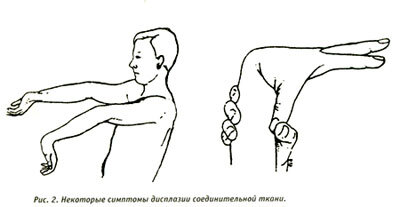    Из множества регуляторных процессов, протекающих в «недрах» соединительной ткани, особенно необходимо выделить те, которые обеспечивают иммунную защиту организма. Если соединительно-тканная «емкость» зашлакована и работает неадекватно, то иммунные клетки движутся или слишком медленно (и тогда не успевают достичь нужного органа или объекта-мишени), или вступают в иммунную реакцию недостаточно зрелыми. Это приводит к развитию огромного спектра атоний и аллергий, в том числе крапивницы, бронхиальной астмы, диатезов, коллагеногенезов, артритов и др.