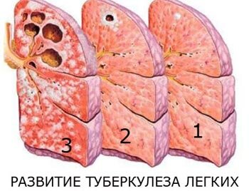 Туберкулез легких: формы, стадии, симптомы, лечение