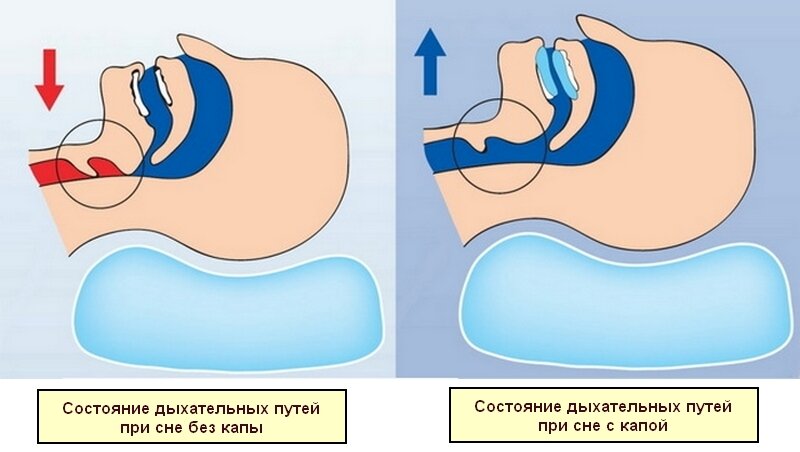 Схематичное изображение состояния дыхательных путей при сне с капой и без нее 