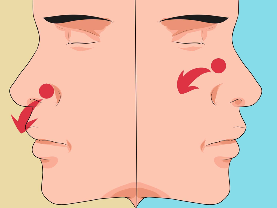 Носовые кровотечения у подростков. Переднее и заднее носовое кровотечение.