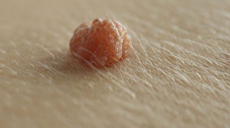 Папиллома на коже