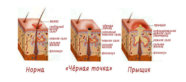 Атерома на УЗИ что это и как выглядит