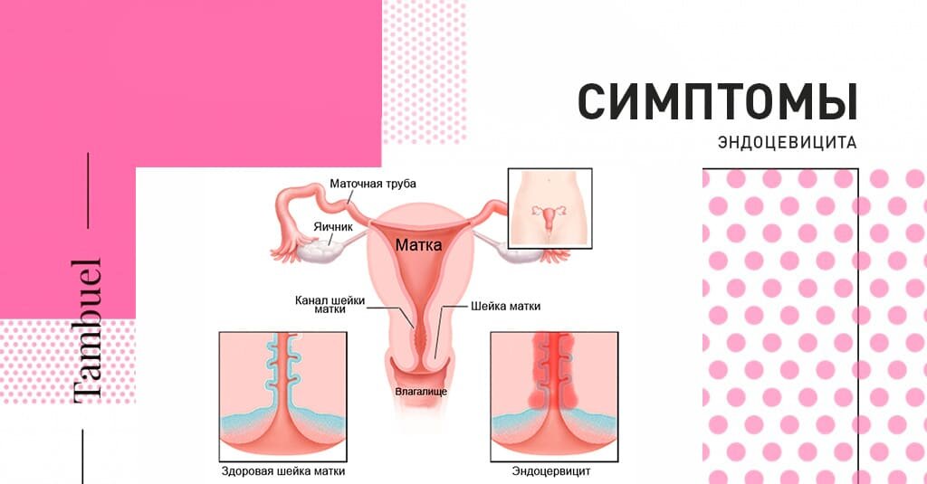 Эндоцервицит свечи