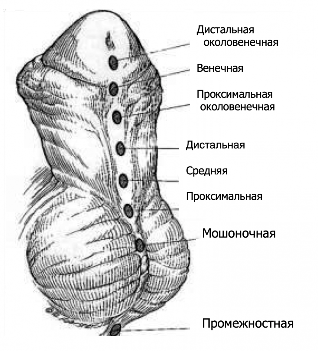 гипоспадия писающие порно