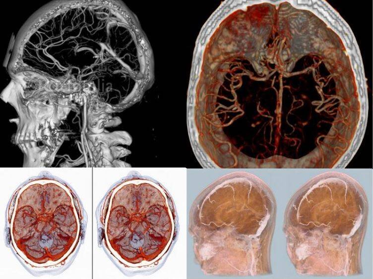 Кт головного мозга картинки