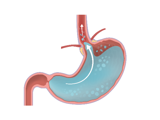 На картинке показано, как желудочное содержимое попадает в пищевод («рефлюкс») 