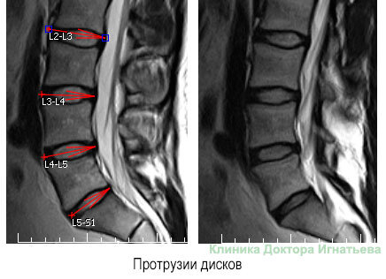 Мр картина нарушения статики