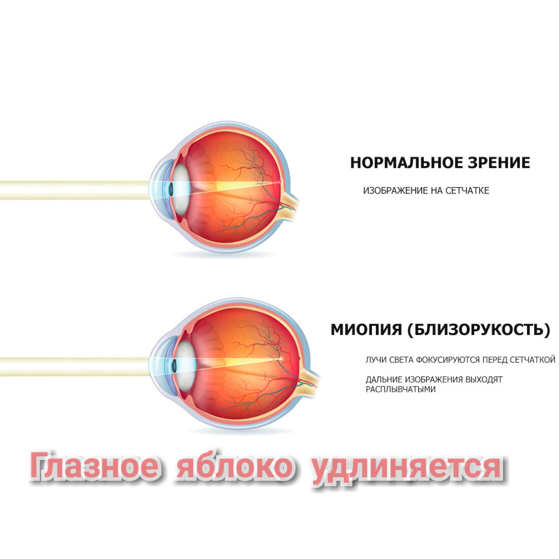 Приплюснутое глазное яблоко