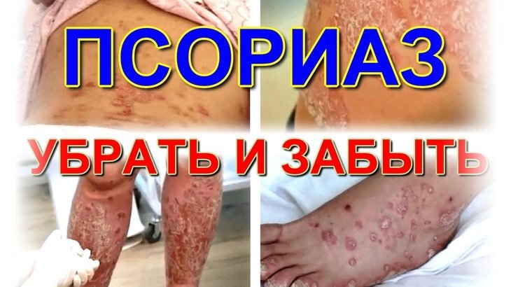 Псориаз - причины, симптомы, методы лечения. Медицинский центр 