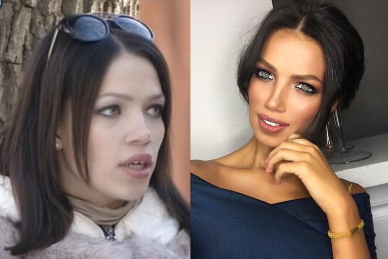 Инесса до и после пластики