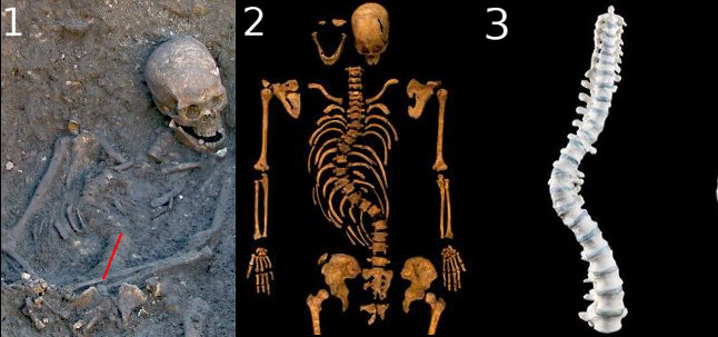 Позвоночник Ричарда в разных видах