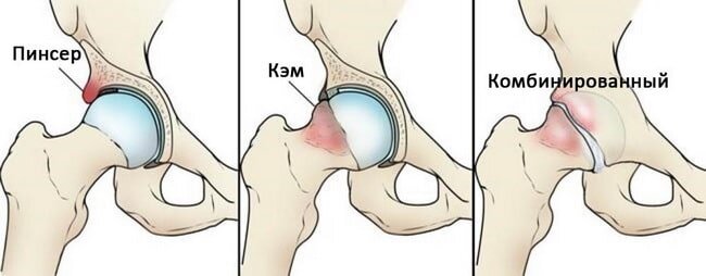 типы импинджмент синдрома