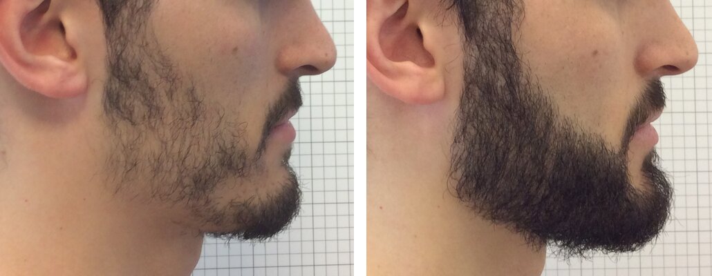 Как сделать так чтобы росла борода чаще брить