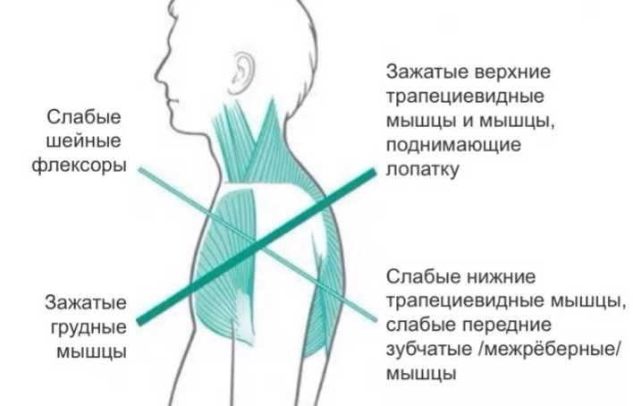 Мышечное перенапряжение в шейном отделе позвоночника вызванное потребностью компенсации и стабилизации. Что это к чему приводит.