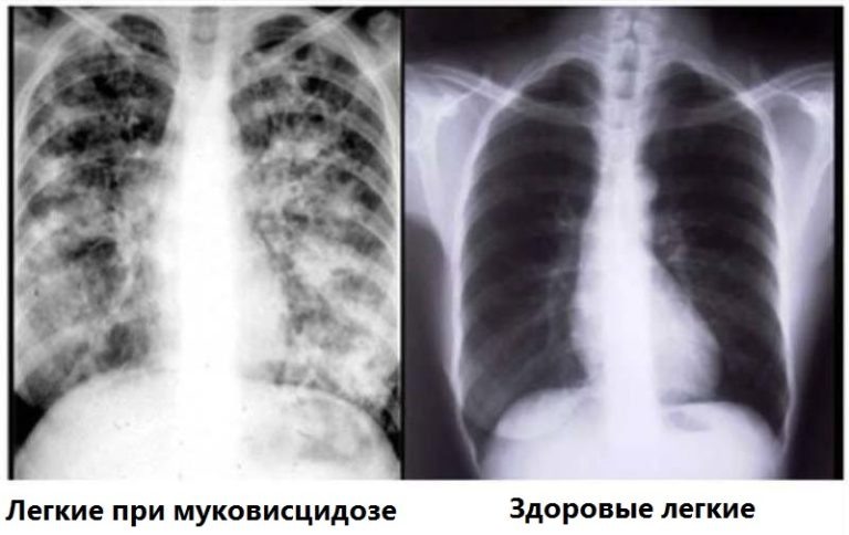 Легкие здорового человека и человека, болеющего муковисцидозом.