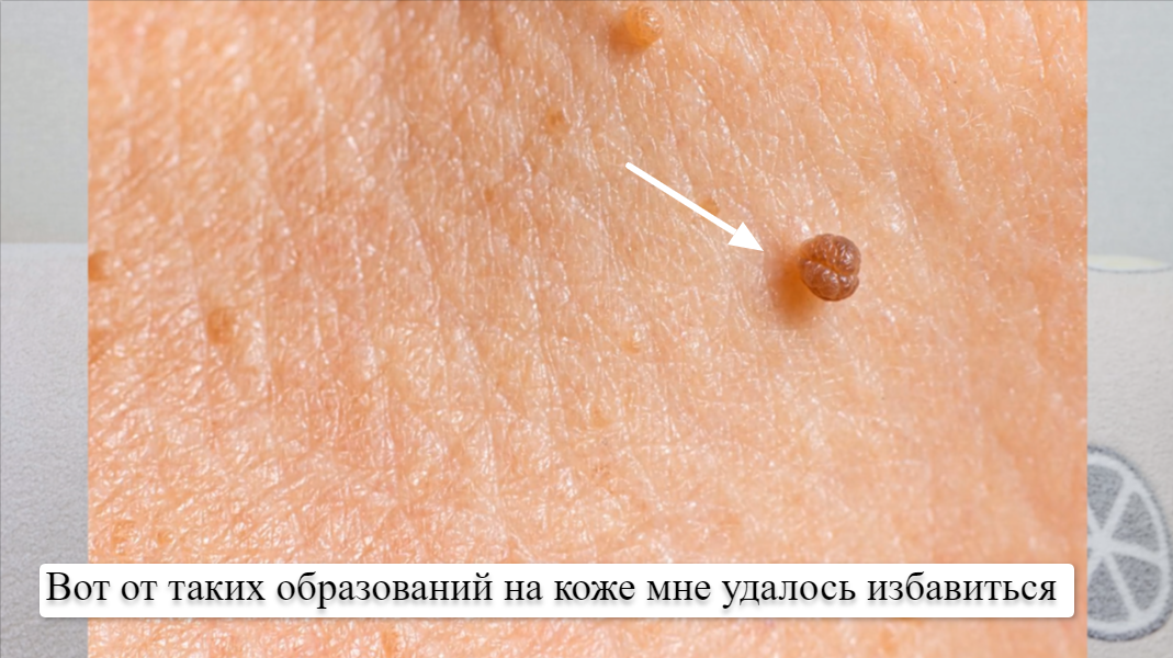 Папилломы, бородавки и шипицы в сторону! Супер-средство вместо азотного ...