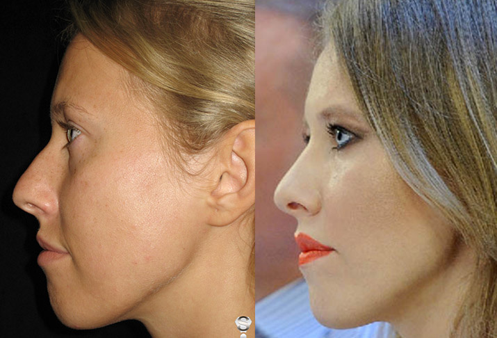 Ксения Собчак до и после пластики