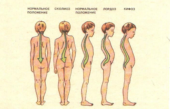 Искривления позвоночника встречающиеся у детей при несоответствии мебели их росту