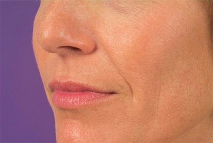 Такое - кожа будет западать и обвисать. Фото из свободного доступа.