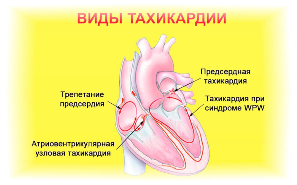 Тахикардия при низком давлении что. Тахикардия. Тахикардия сердца. Учащенное сердцебиение тахикардия. Тахикардия сердца симптомы.