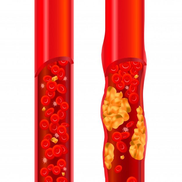 Схематичное изображение сосуда забитого атеросклеротическими бляшками. Источник https://www.freepik.com/