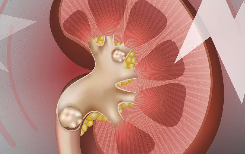Камни в почках: причины, симптомы и лечение