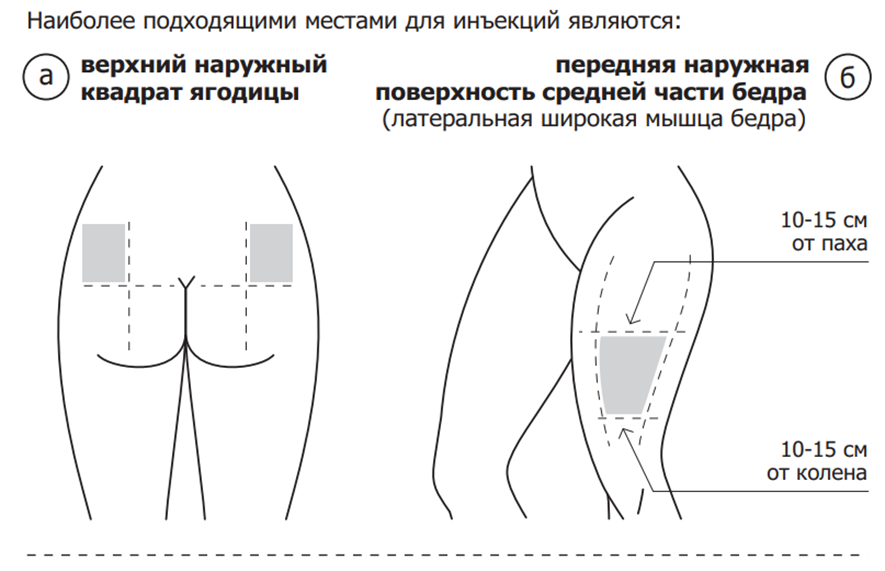 Куда правильно ставить укол в ягодицу взрослому - CollectPhoto.ru