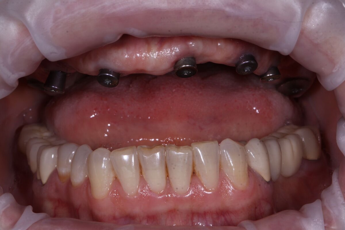 "От" Полость рта с имплантатами