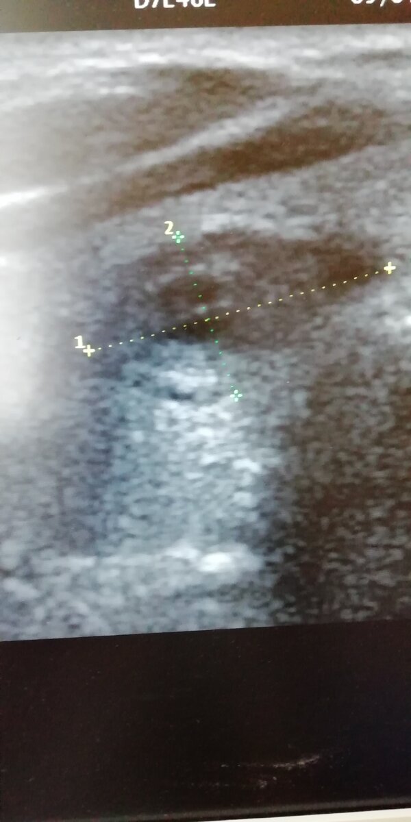 Так выглядит узел в щитовидке с кистой в центре. Фото автора.