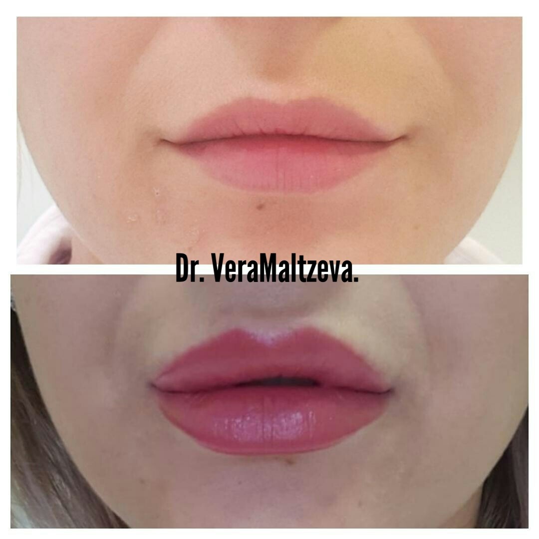 Контурная пластика - самая востребованная процедура в косметологии. Сразу после процедуры мы видем результат!!! 