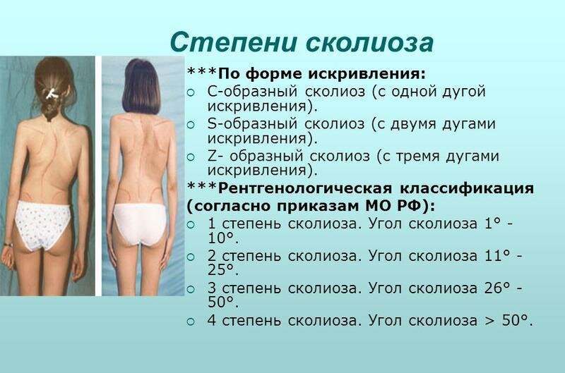 Что такое сколиоз. Сколиоз позвоночника код по мкб 10 у детей. Сколиозе степень искривления позвоночника. Сколиоз 1 степени искривления позвоночника. S образный грудопоясничный сколиоз 2 степени объективно.