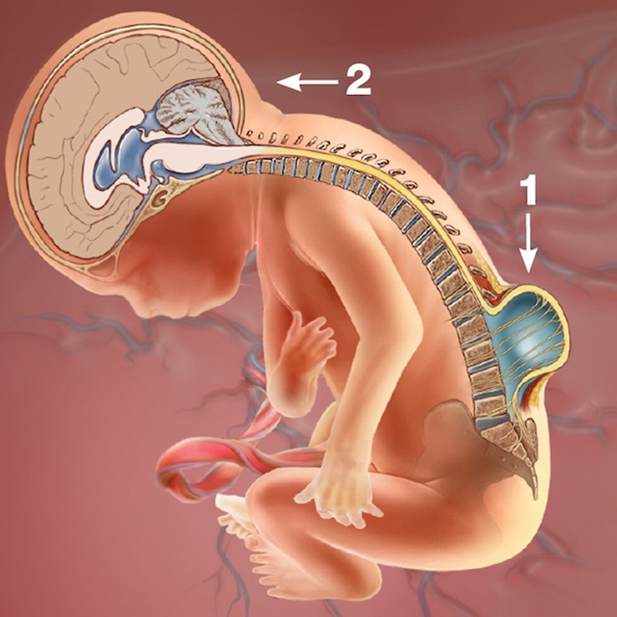 Внутриутробное поражение головного мозга. Spina Bifida внутриутробная операция. Дефект нервной трубки спина бифида. Spina Bifida (расщепление позвоночника). Спина бифида и аномалия Киари.