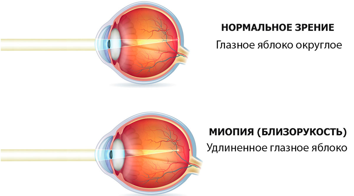 Плюс и минус в очках — что это значит? | Эксимер, офтальмологическая  клиника | Дзен