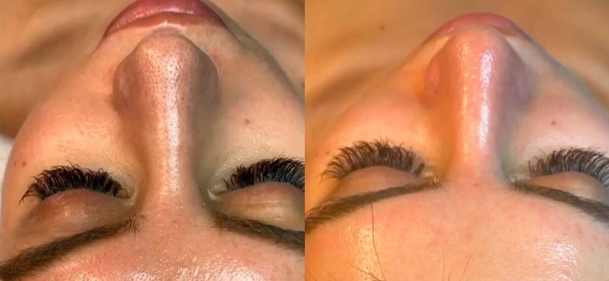 Процедура HydraFacial для чувствительной кожи. Фото из инстаграм клиники. Имеются противопоказания, требуется консультация специалистов