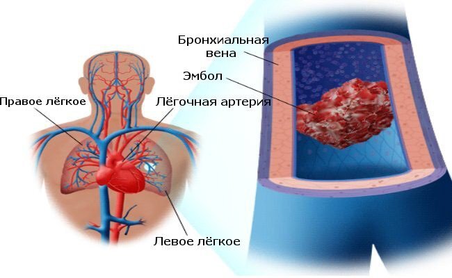 Боль в спине при вдохе. Что делать?