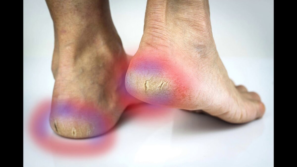 Трещины на пятках. Фото из открытых источников Яндекса