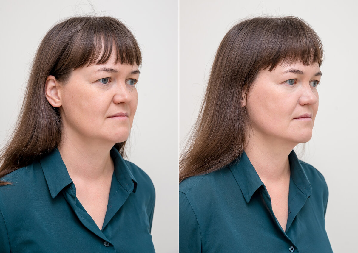 Фото до и сразу после процедуры