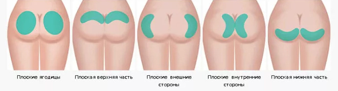 Способы размещения имплантов