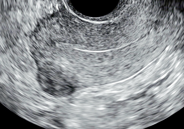 УЗ-признаки миомы матки малых размеров.