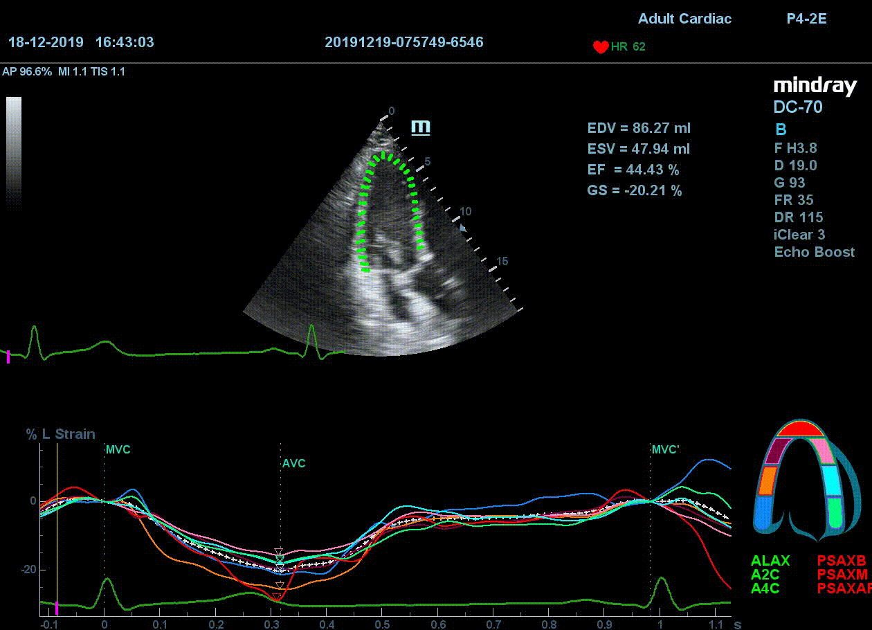 Технология Speckle-tracking на УЗИ аппарате DC-70 Pro X-Insight