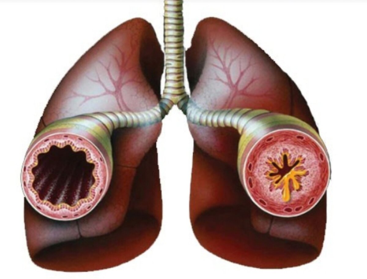 Бронхиальная обструкция