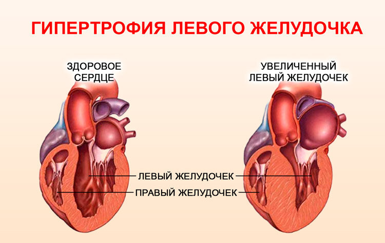 Гипертрофия левого предсердия