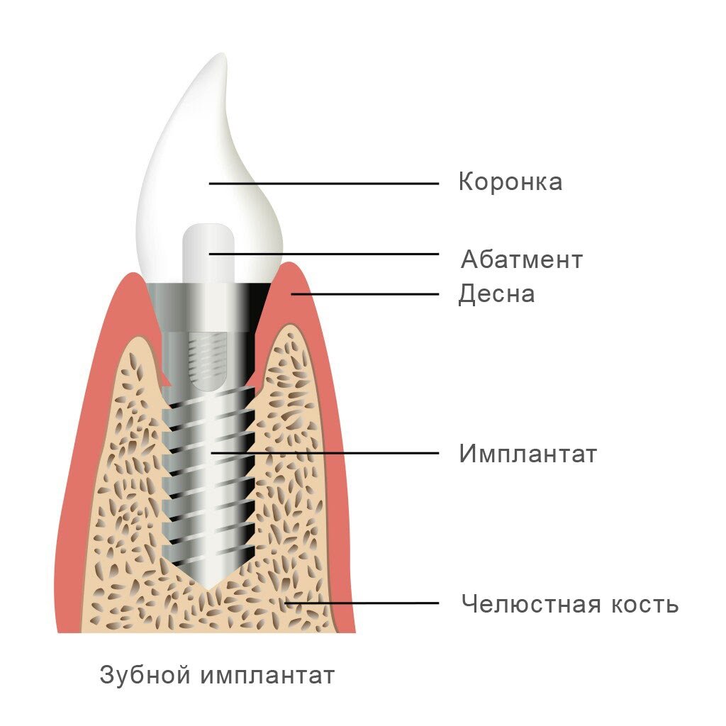 Строение классического имплантата.