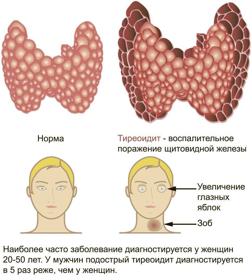 Гиперплазия щитовидной железы что это такое. Аутоиммунный тиреоидит 1ст. Тиреоидит щитовидной железы признаки. Хронический тиреоидит ЩЖ. Хронический аутоиммунный тиреоидит синдромы.