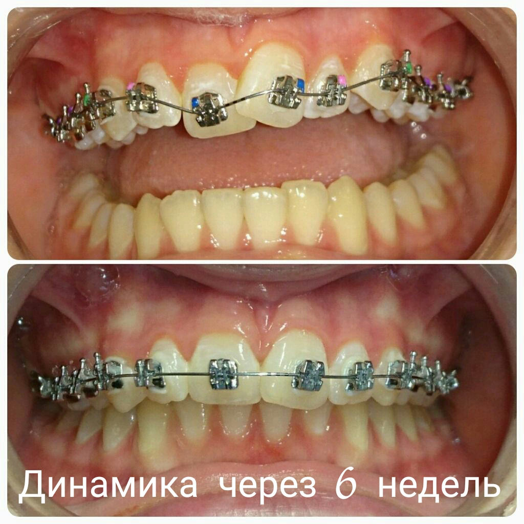 Mini diamond ormco. Mtx брекеты. сколько будет стоить установка брекетов. брекеты металлические micro arch. самолигирующие брекеты.