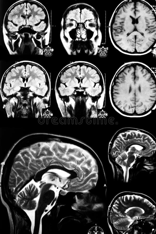 https://thumbs.dreamstime.com/b/brain-mri-23403809.jpg