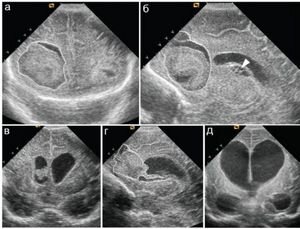 Субэпендимальные кисты и размер большого родничка у детей первого года жизни