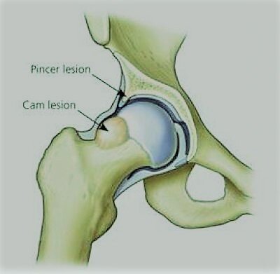 Cam - импинджмент и pincer- импинджмент. Фото взято с интернета